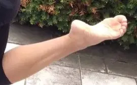 meaning-dream-snakes-biting-attacking-left-leg